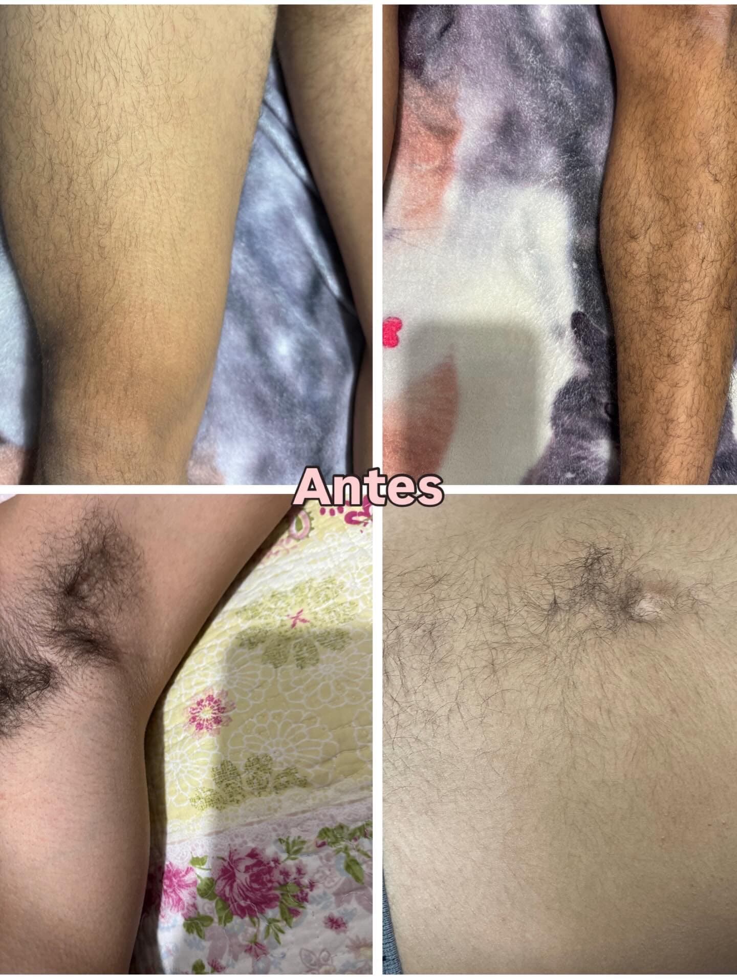 Antes de depilação a laser