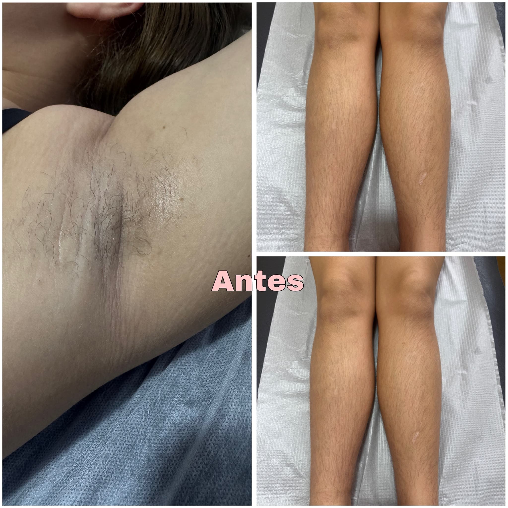 Antes de depilação a laser