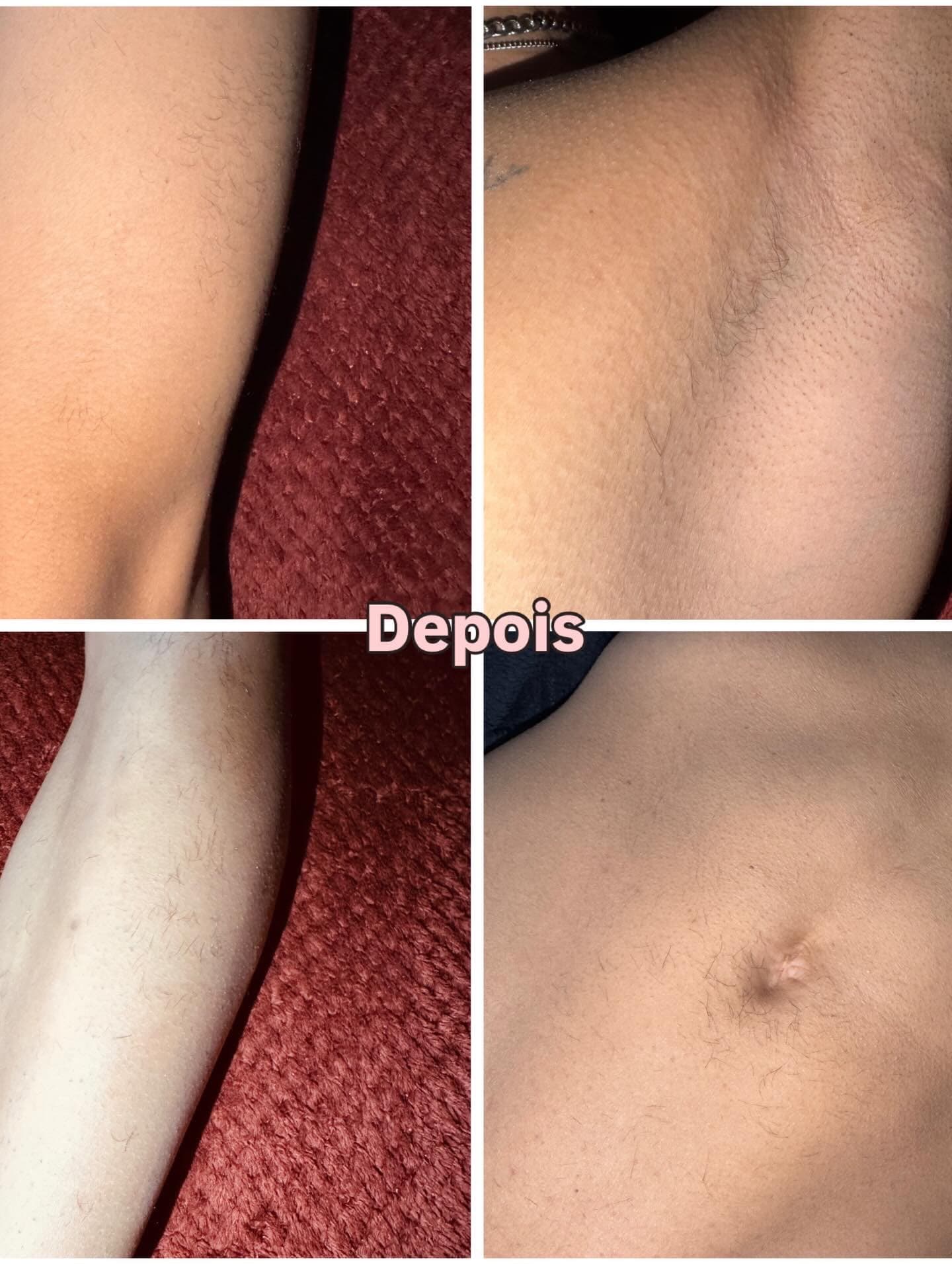 Depois de depilação a laser