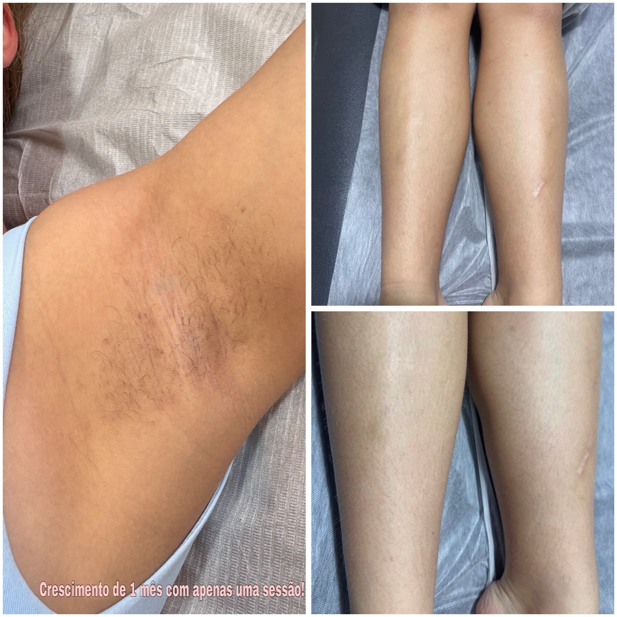Resultado de depilação a laser