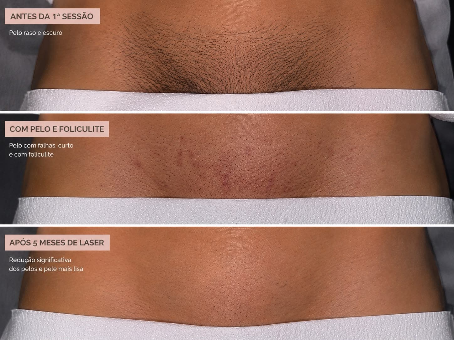 Antes e depois de depilação a laser