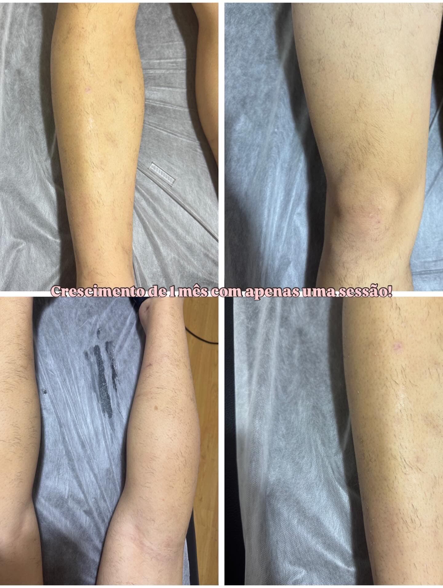 Resultado de depilação a laser após 1 mês